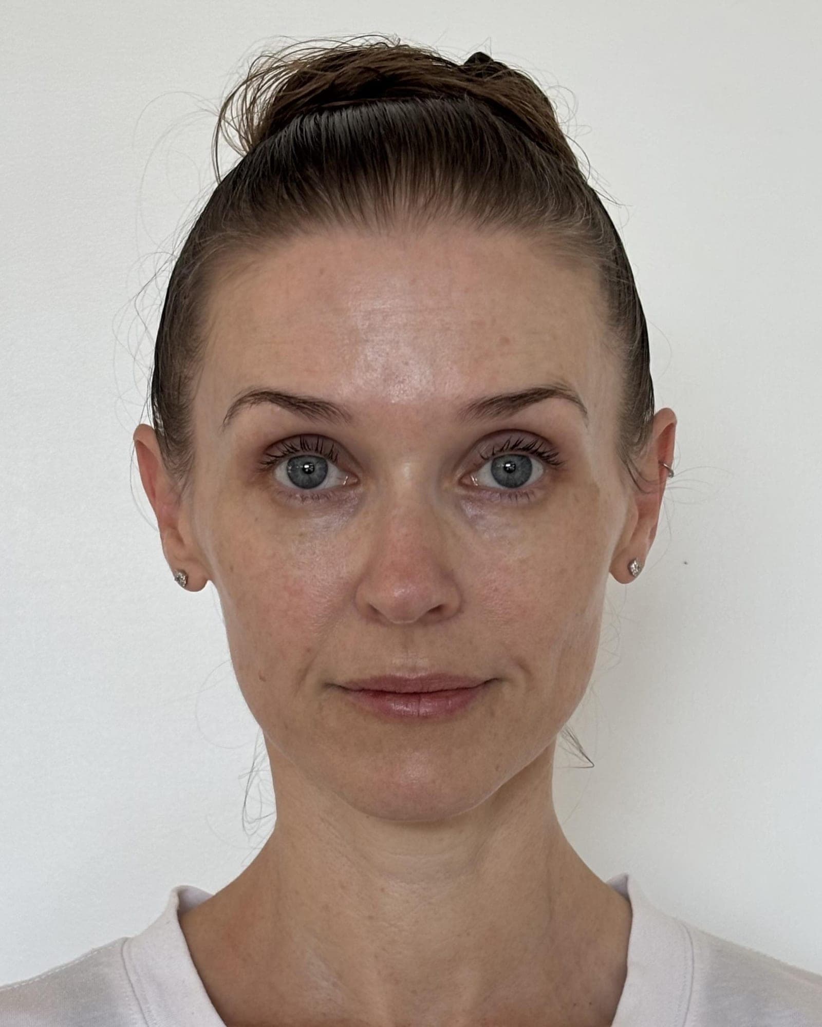 Sheryn's skin before using Système Bio+ Oil Serum
