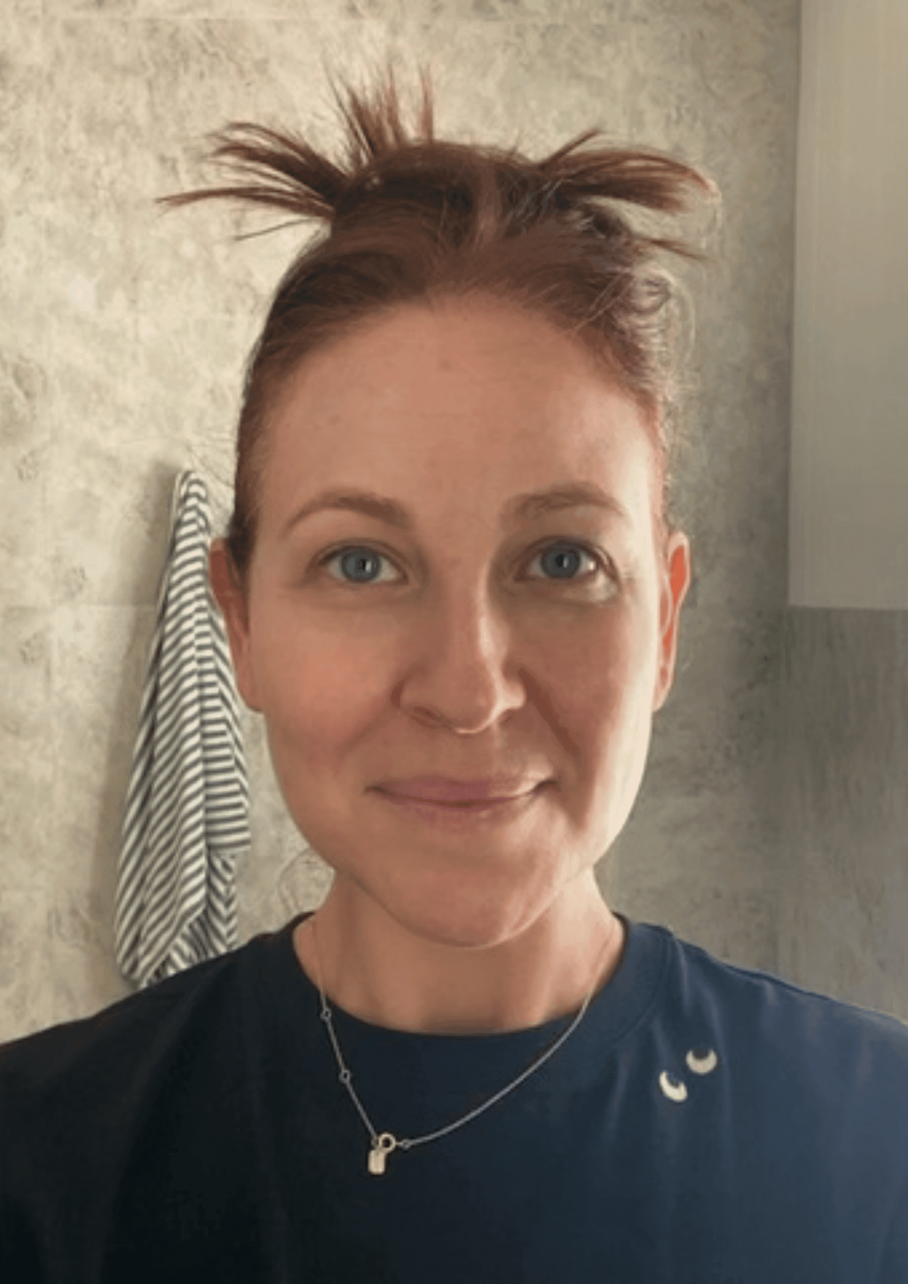 Yaz's skin before using the Qure Micro-Infusion System