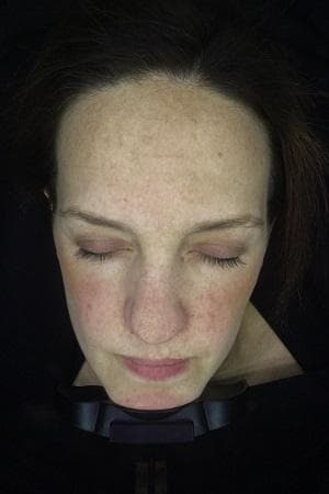 Jenna's Visia machine skin scan before the vitamin A trial