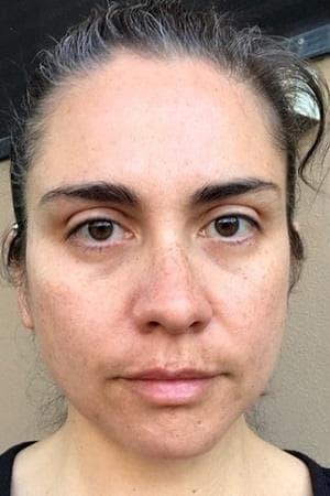 Katrina's skin after eight weeks - reduced pigmentation and clearer complexion