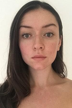 Allanah's sensitive skin before using the Dermalogica Ultracalming Duo