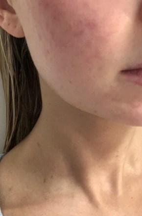 Gracie's post-acne sensitive skin before using the Dermalogica Ultracalming Duo