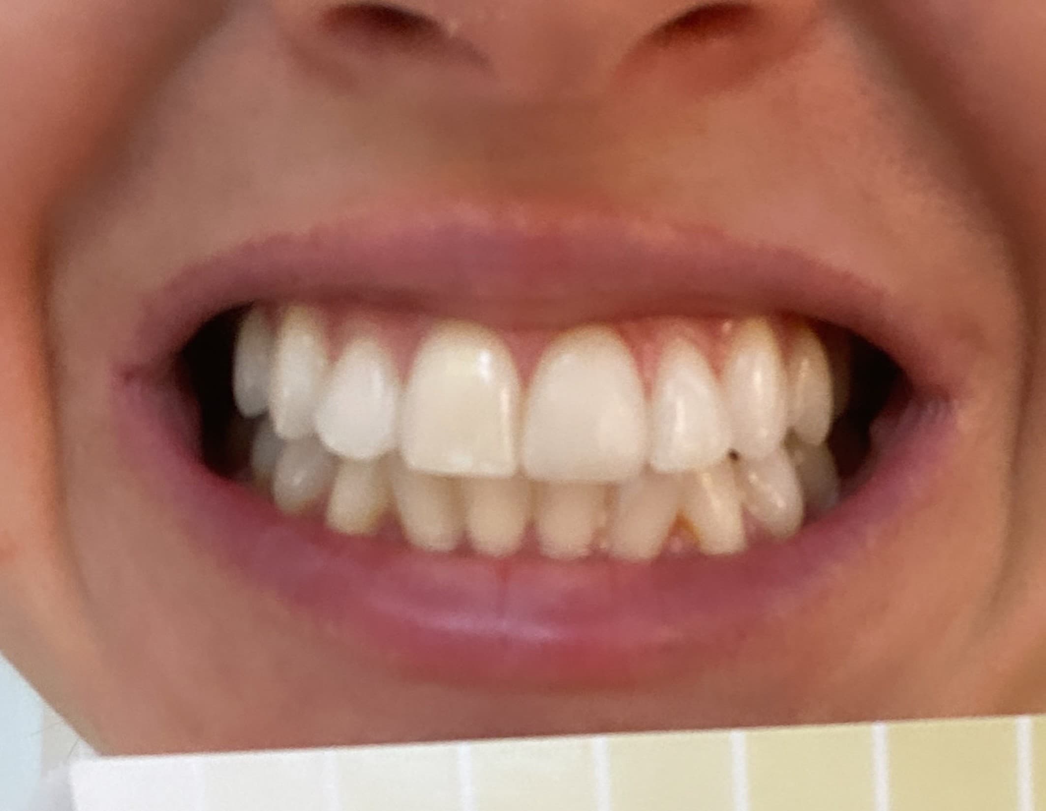 Teeth before HiSmile whitening treatment with colour guide