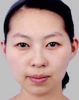 Before (Image: Wonjin Plastic Surgery)