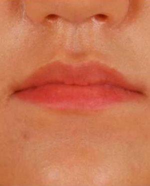 Before (Image: Wonjin Plastic Surgery)
