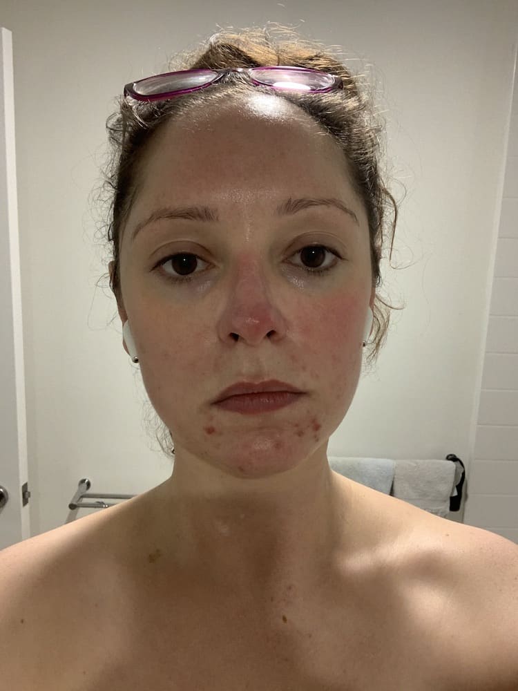 This, my friends, is called a flare up. Note the inflamed spots on my chin and persistent redness, always particularly noticeable on my nose and cheek