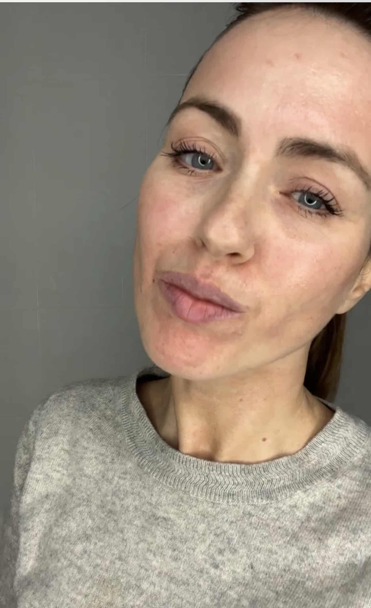 Skin looking lightly pink straight after a micro-infusion treatment.