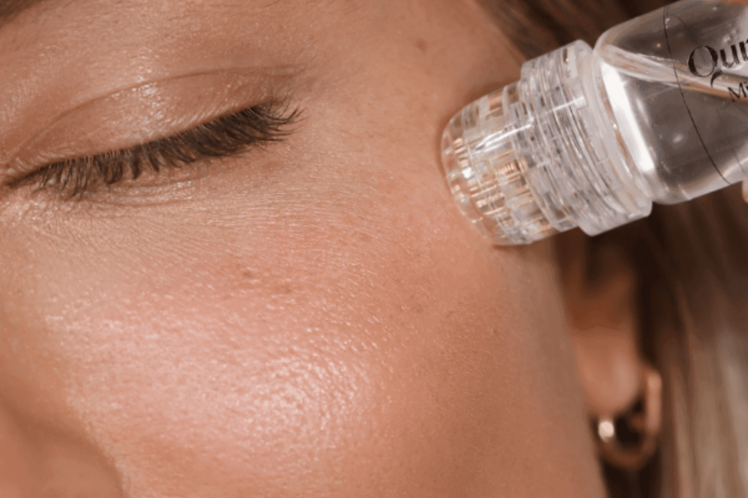 Before and after results using the Qure Micro-Infusion System