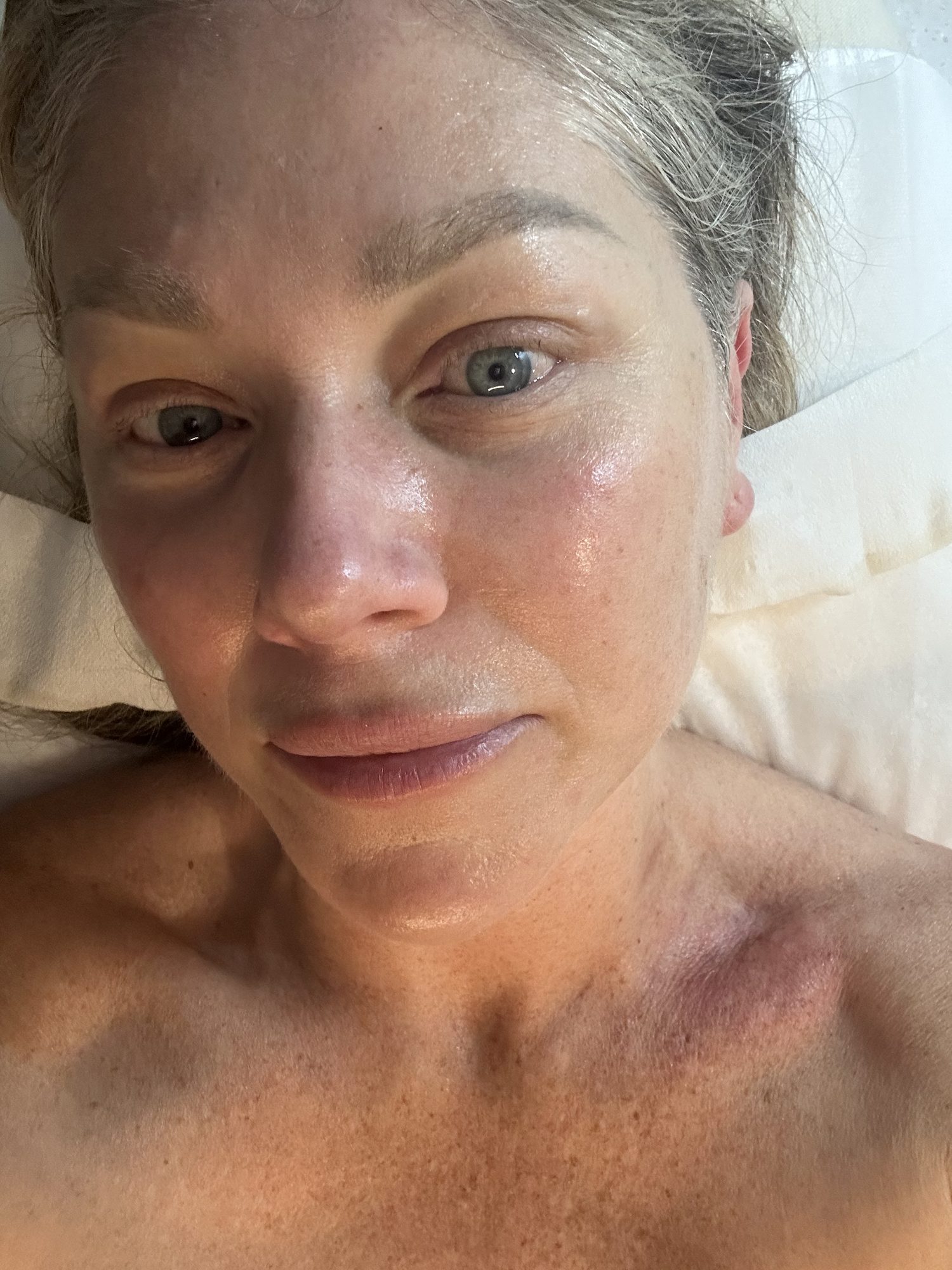 Close-up selfie of Colette lying down, with visible redness across her chest and shoulder