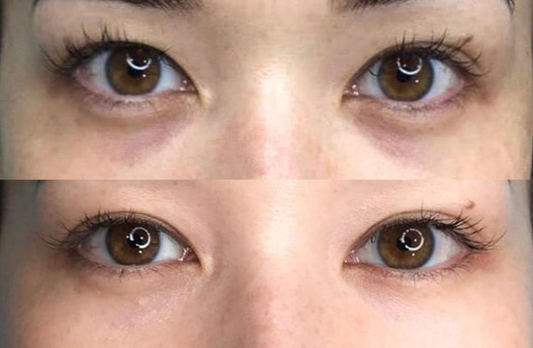 Permanent Under-Eye Concealer Tattoo: It's Now A Thing - Beauticate