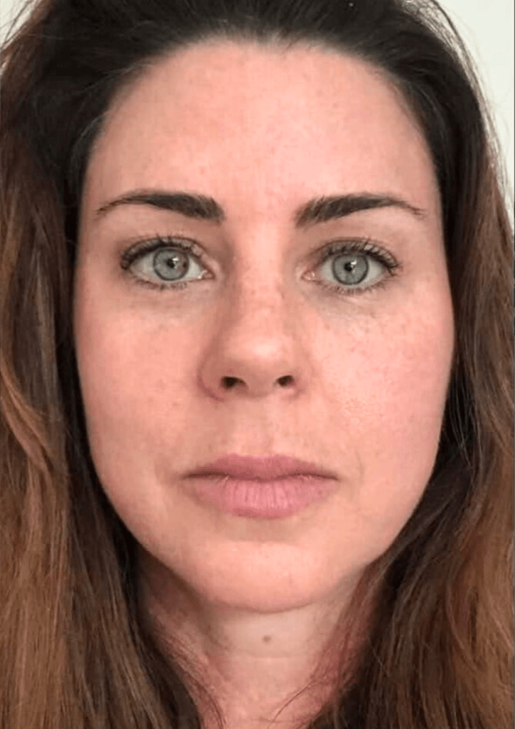 Before and after results using the Qure Micro-Infusion System